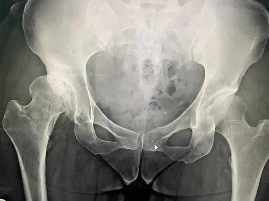 hip replacement